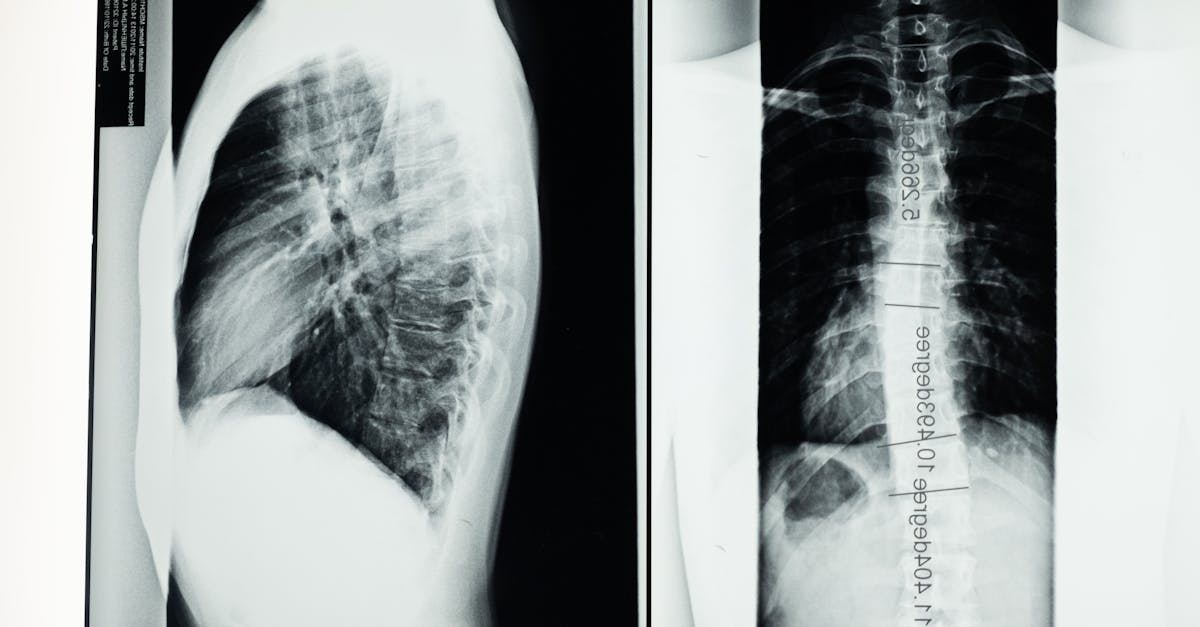 discover everything you need to know about scoliosis, including its causes, symptoms, diagnosis, and treatment options. learn how to manage this spinal condition and improve your quality of life.