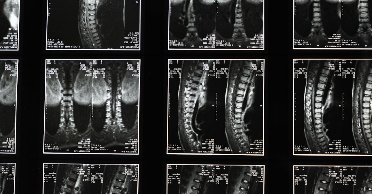 discover the causes, symptoms, and treatment options for spinal stenosis. learn how this condition affects the spinal canal and find effective ways to manage pain and improve mobility.