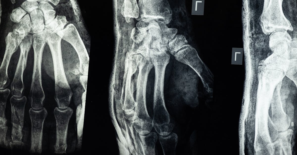explore the causes, symptoms, and treatment options for brachial plexus injuries. understand how these nerve injuries affect mobility and sensation in the arm, and learn about the latest advancements in medical care and rehabilitation.
