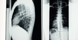 discover essential insights about scoliosis, its causes, symptoms, and treatment options. learn how early diagnosis and tailored therapies can significantly improve quality of life for those affected by this condition.