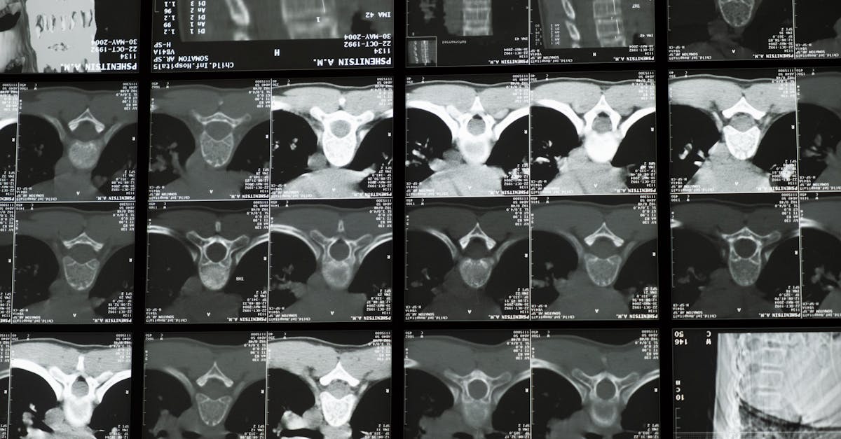 discover comprehensive insights on scoliosis, its causes, symptoms, and treatment options. learn how early diagnosis and interventions can improve quality of life for those affected by this spinal condition.